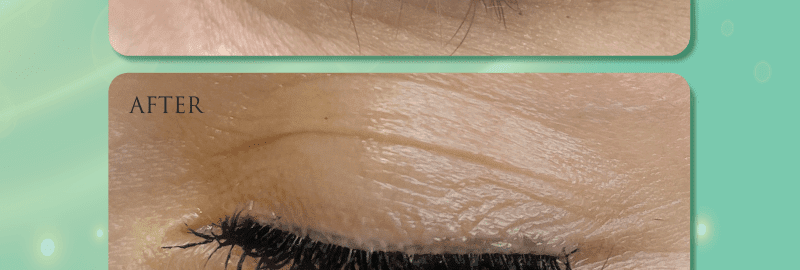 tattoo removal course near metattoo removal course near me